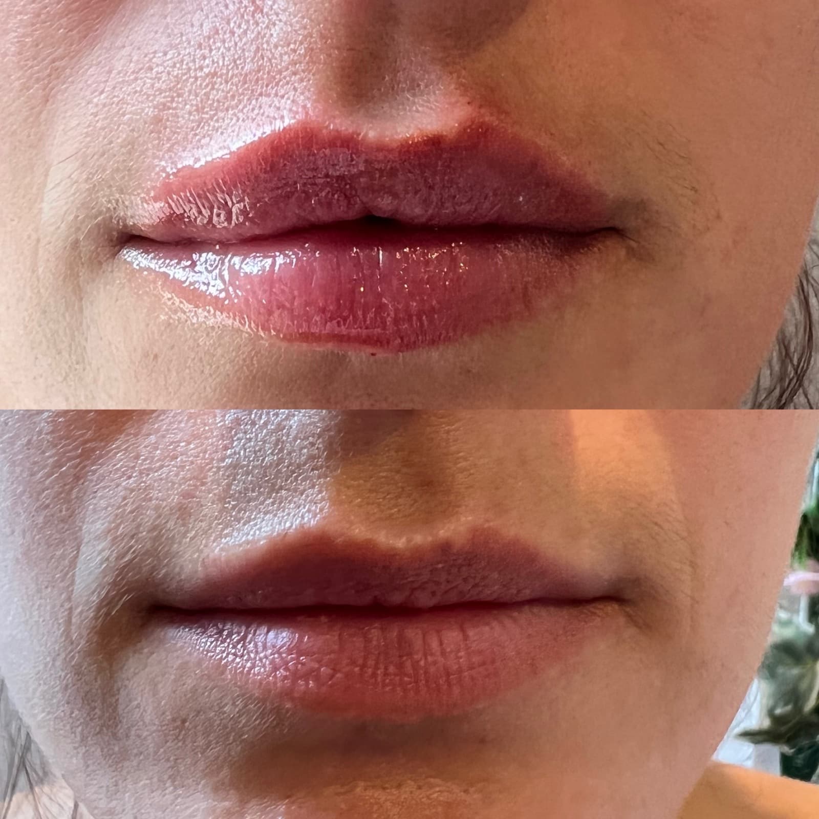 Are Lip Fillers Safe?