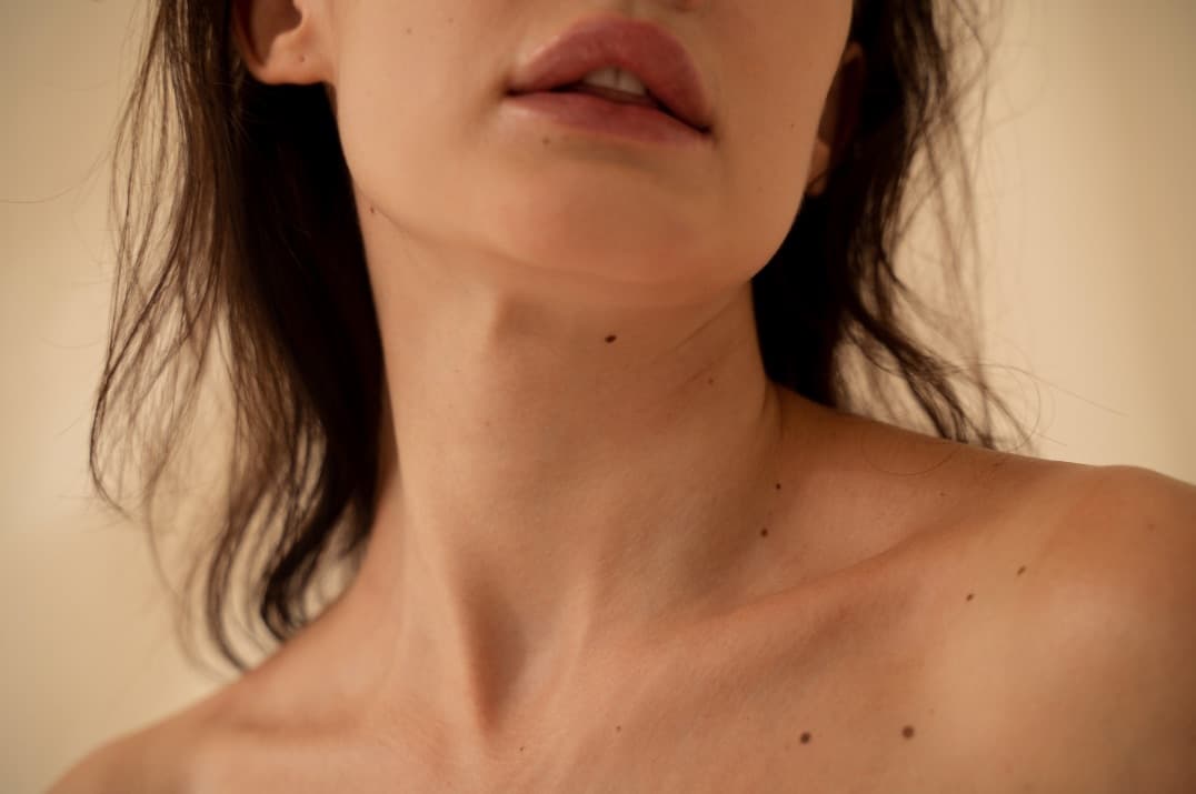 How do polynucleotides differ from other skin boosters like Profhilo?