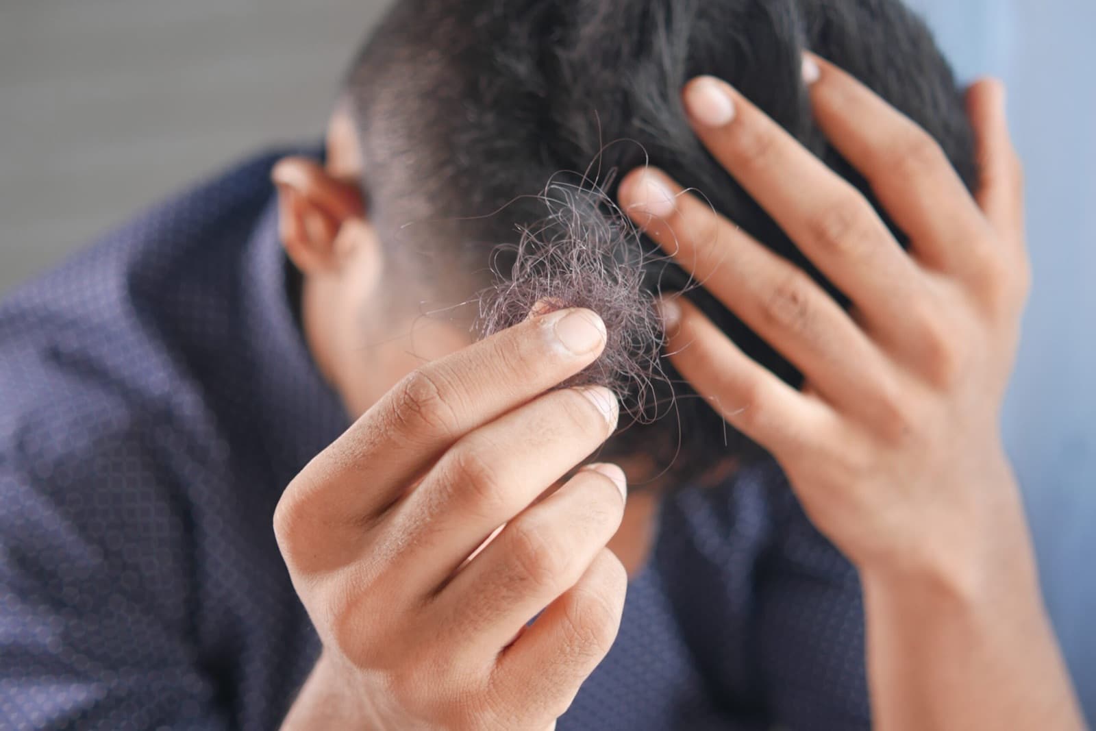 PRP for Hair Loss: A Safe and Effective Regenerative Treatment